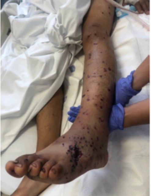 Scores of pellets embedded in a protesters’ leg.