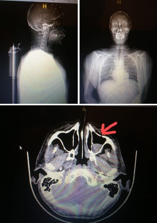 Dozens of pellets wounded this protester, puncturing their scalp and embedding under their sinus and in their eye.