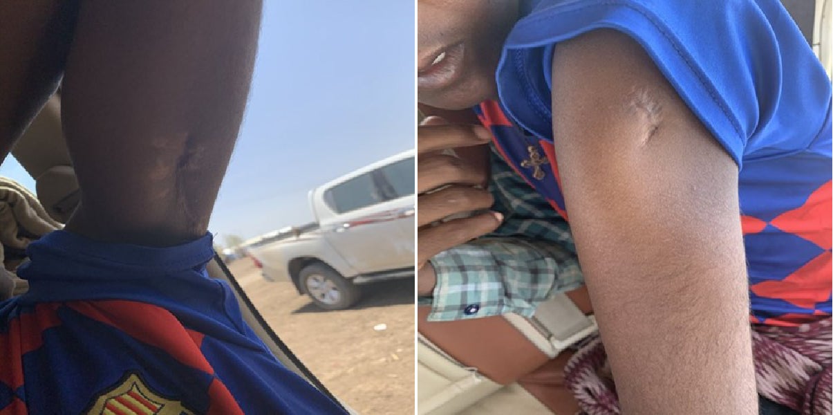 Two close up images of scars