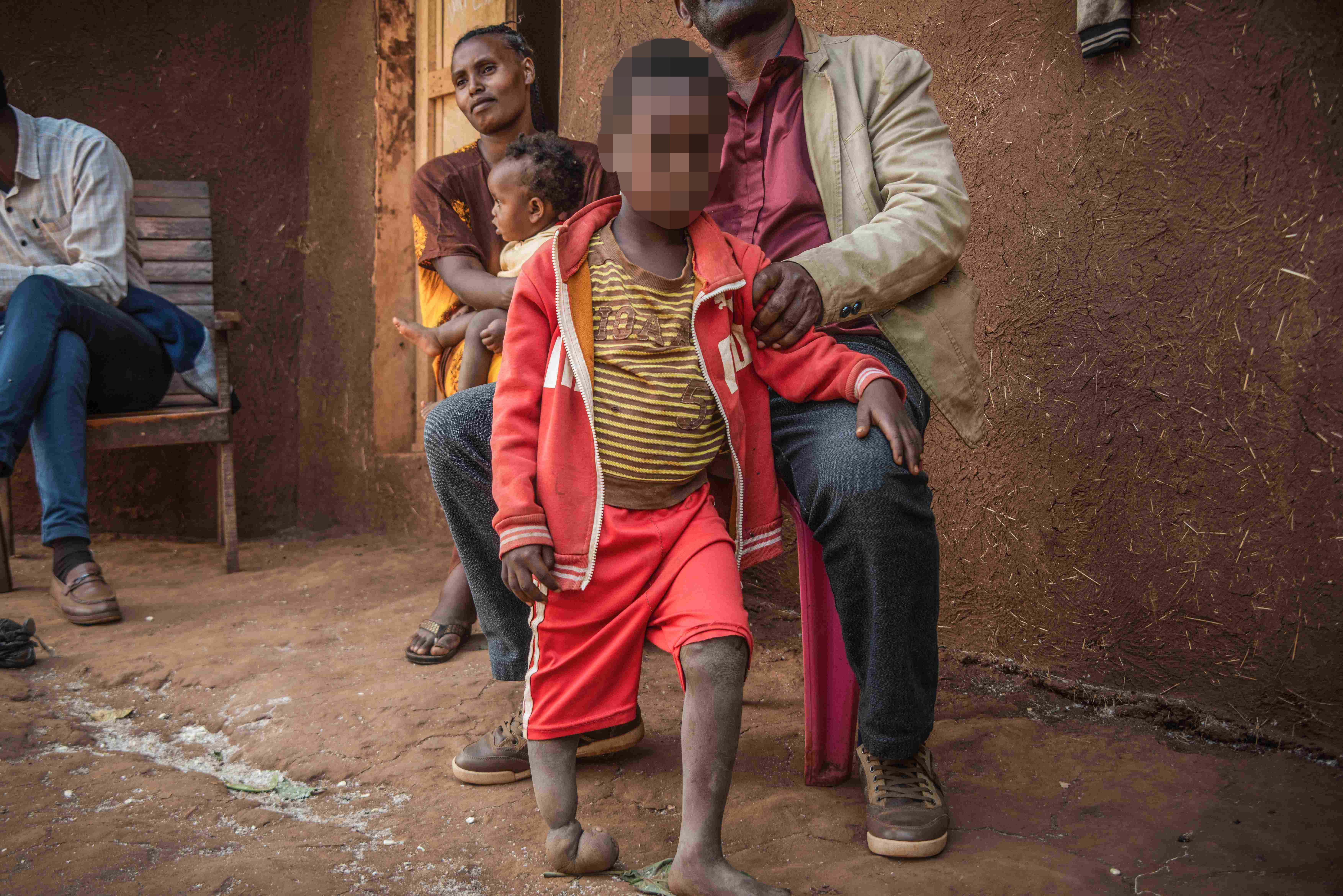 A 6-year-old boy, born near Lega Dembi gold mine in the Oromia region of Ethiopia, has no bones in his right foot and three toes on his left foot. 