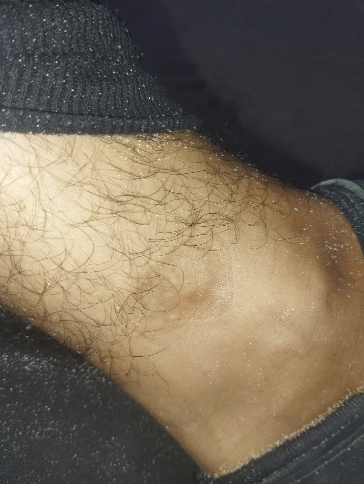Visible marks on Walid Khalili’s foot/ankle from cuffs and electro-shock. Photo taken around April 8, 2024, after Khalili’s release from Israeli detention.