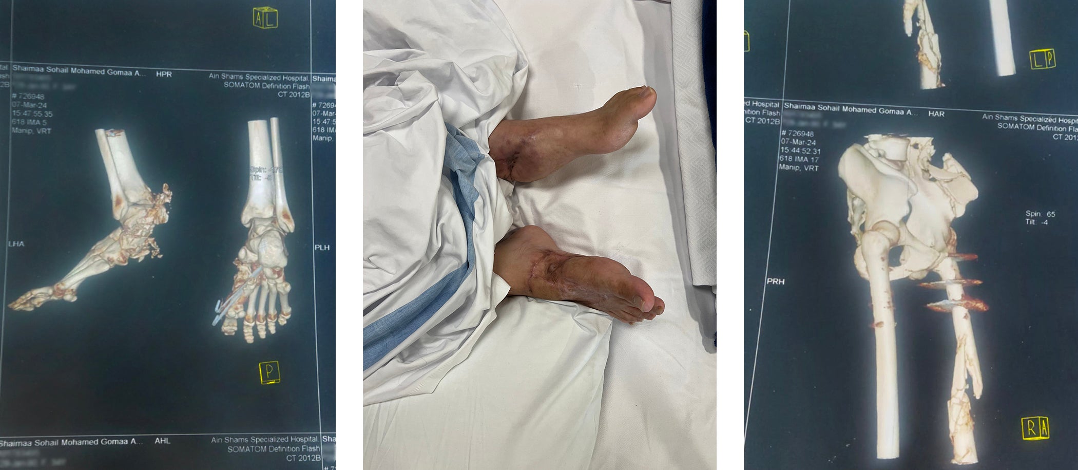 Shaima Abu Jazar’s injuries after an Israeli airstrike. 