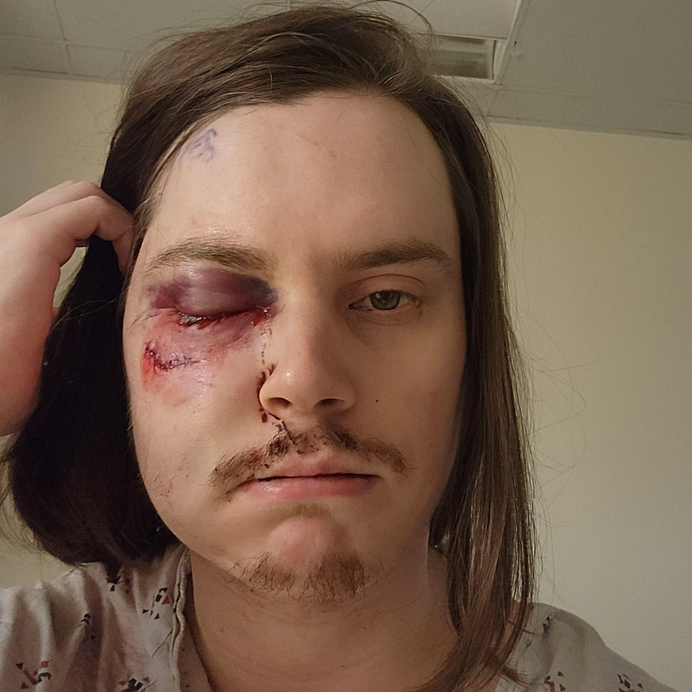 Photo of man with wounds to his eye