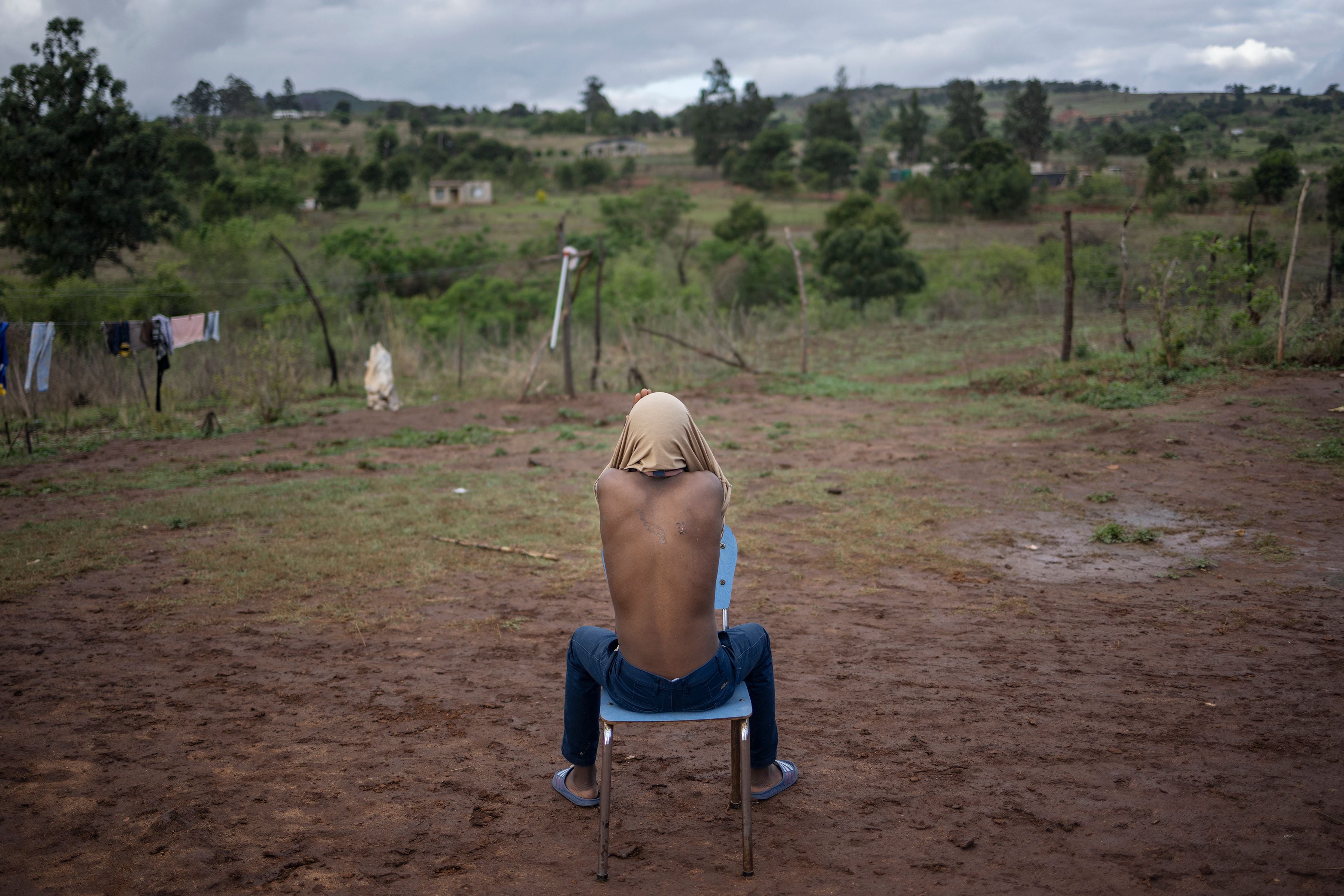 A boy shows a scar on his back allegedly from a rubber bullet 