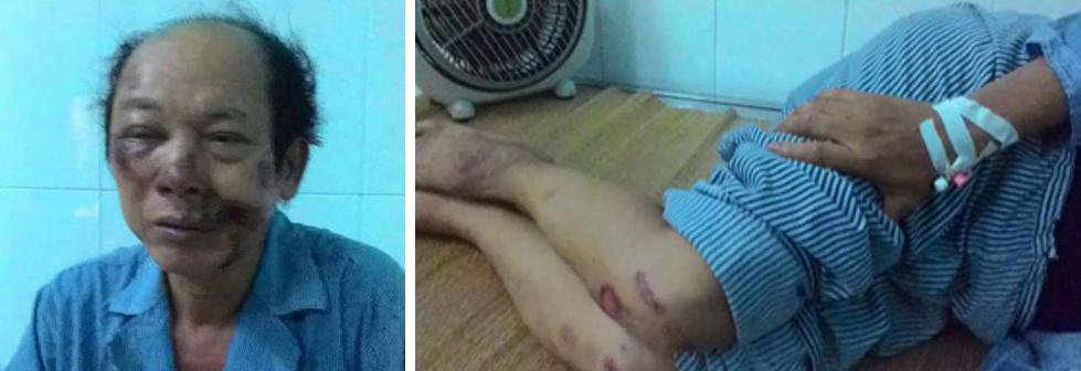 Tô Oanh sau khi bị tấn công ở Bắc Giang ngày 13 tháng Bảy năm 2016.