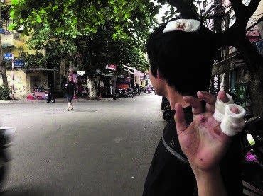 Trịnh Anh Tuấn sau khi bị hành hung ở Hà Nội ngày 22 tháng Tư năm 2015.