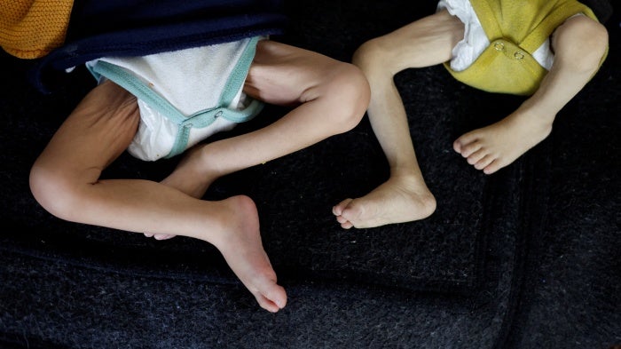 Palestinian children suffering from malnutrition receive treatment at a healthcare center, in Rafah, in the southern Gaza Strip, March 4, 2024.