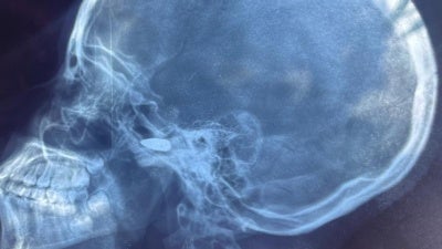 Radiographie d'une fille de 15 ans qui a été touchée à la tête par une balle perdue à Bébédja, au sud du Tchad, le 9 mai 2024, après l'annonce des résultats provisoires de l'election présidentielle au Tchad.