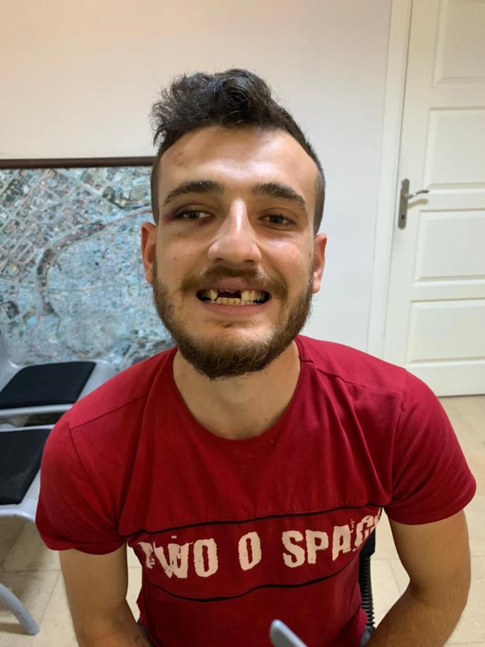 Halit Eray Tosun, polis karakolunda üç dişini kıran polis memurları tarafından dövüldüğünü iddia ediyor.