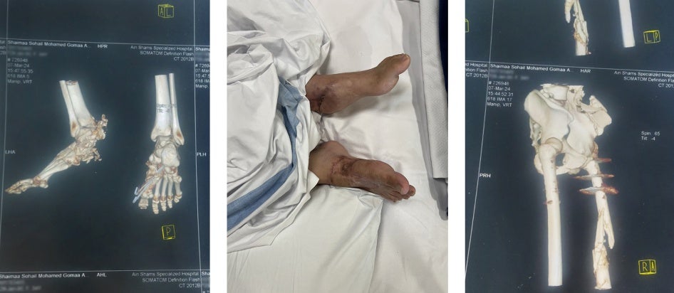 Shaima Abu Jazar’s injuries after an Israeli airstrike. 