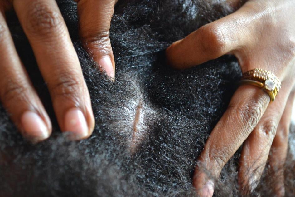 Mkalimani akionyesha kovu kichwani kwa “Basma N.” Basma alisema mtoto wa mwajiri wake aliwasha feni la juu wakati akiwa anasafisha juu ya kabati la vyombo. Feni ilimpiga kichwani kisha akaanguka chini.