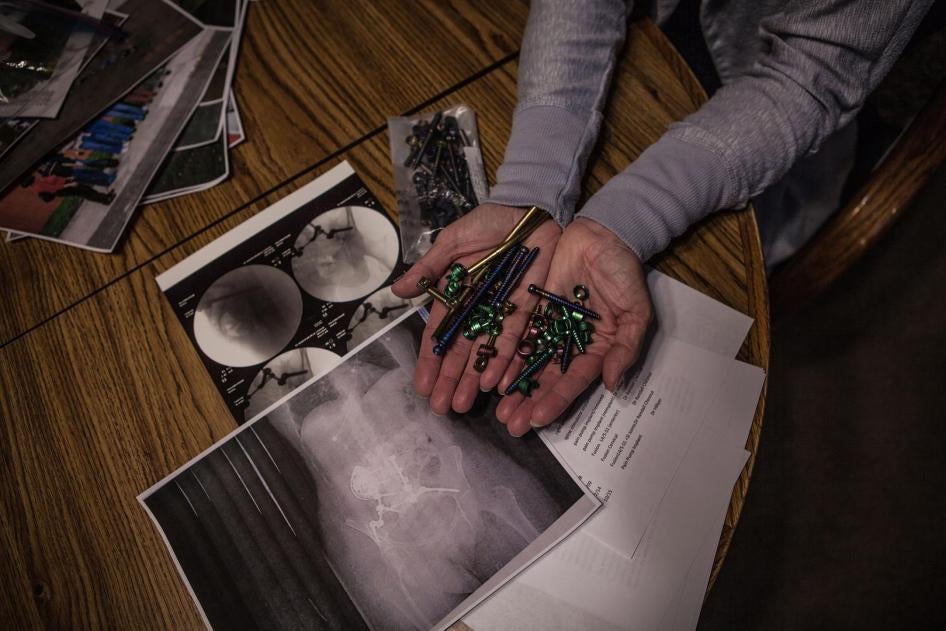 Maria Higginbotham, 57, holding screws and bolts removed from her back in a recent surgery above x-rays of her body.