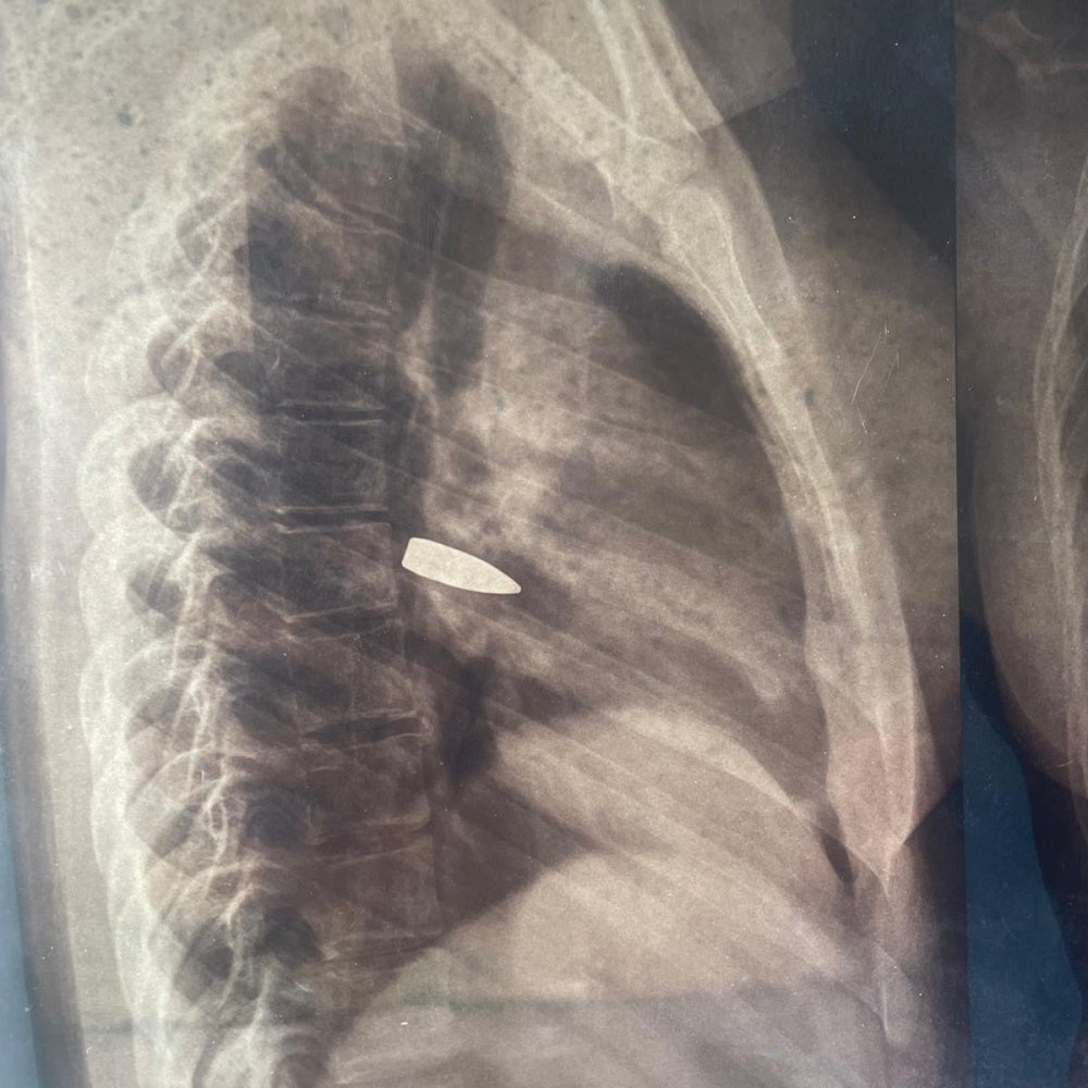 x-ray image of a 17-year-old girl who was struck in the chest by a stray bullet