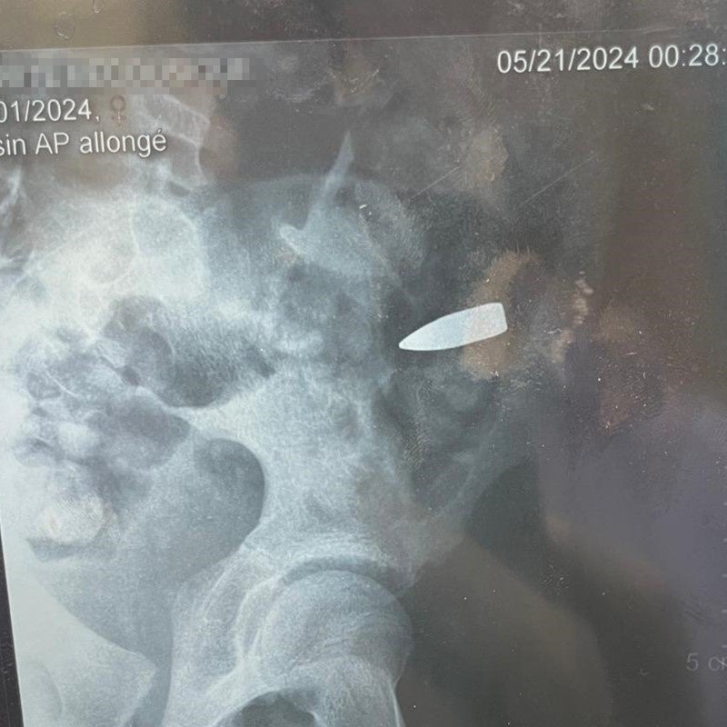 x-ray image of a 13-year-old girl who was struck in the hip by a stray bullet