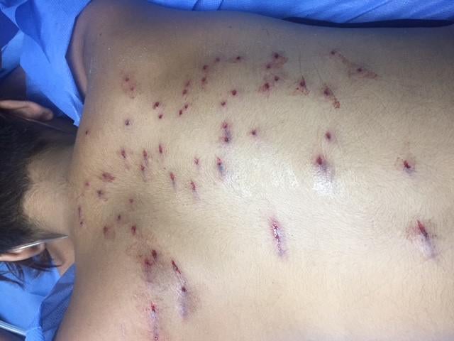 Un manifestante herido por perdigones durante una manifestación contra el gobierno recibe atención médica en Caracas, junio de 2017. 