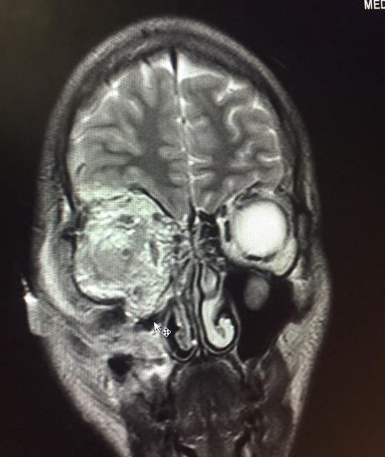 Radiografía de un paciente herido durante una manifestación contra el gobierno en Caracas muestra la lesión provocada en el ojo por el impacto directo de un cartucho de gas lacrimógeno, junio de 2017. 
